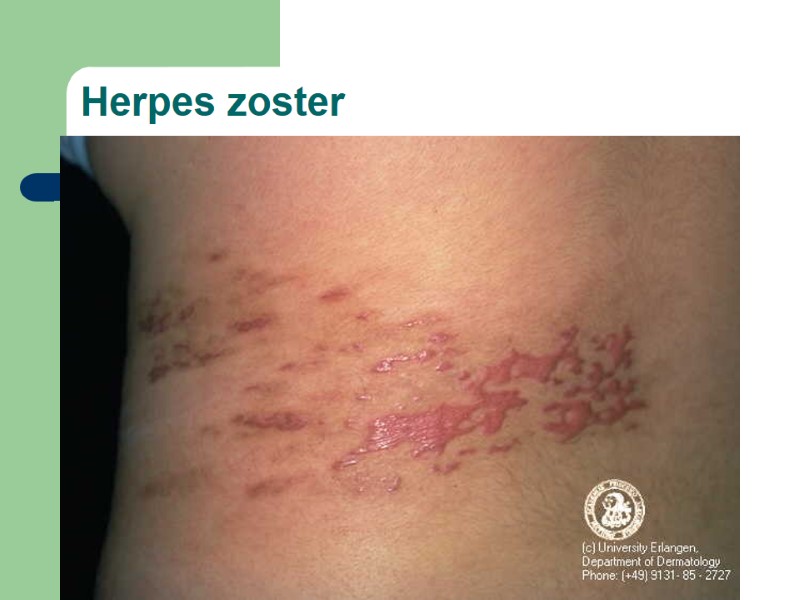 Herpes zoster